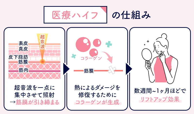 医療ハイフの原理